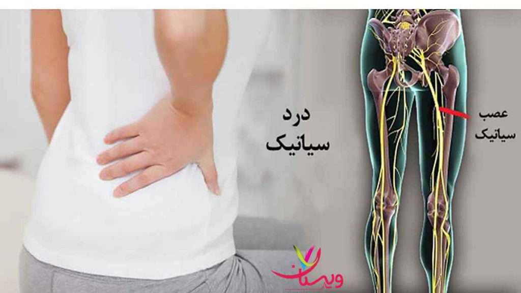 تشخیص دیسک کمر با نوار عصب