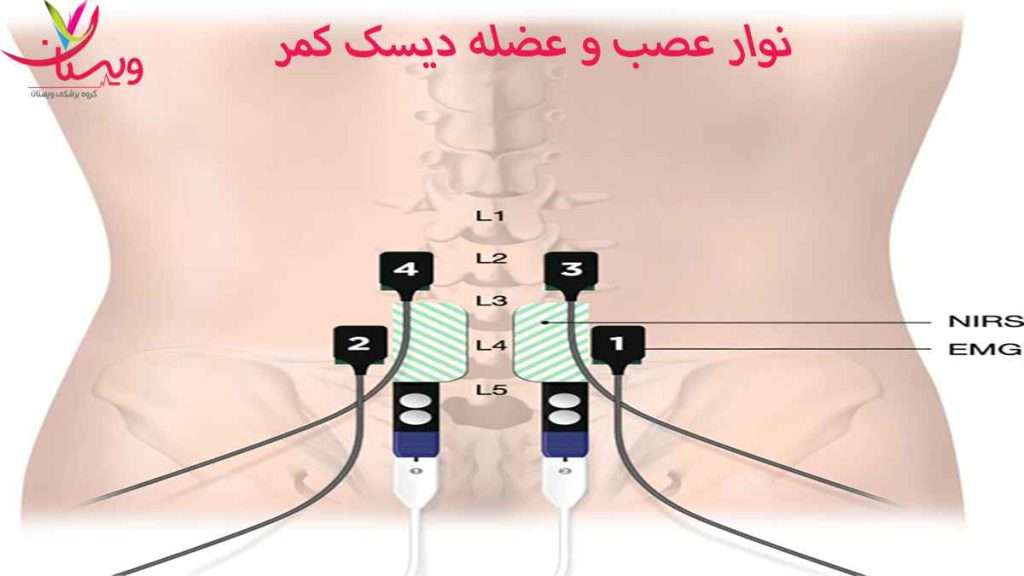 نوار عصب و عضله