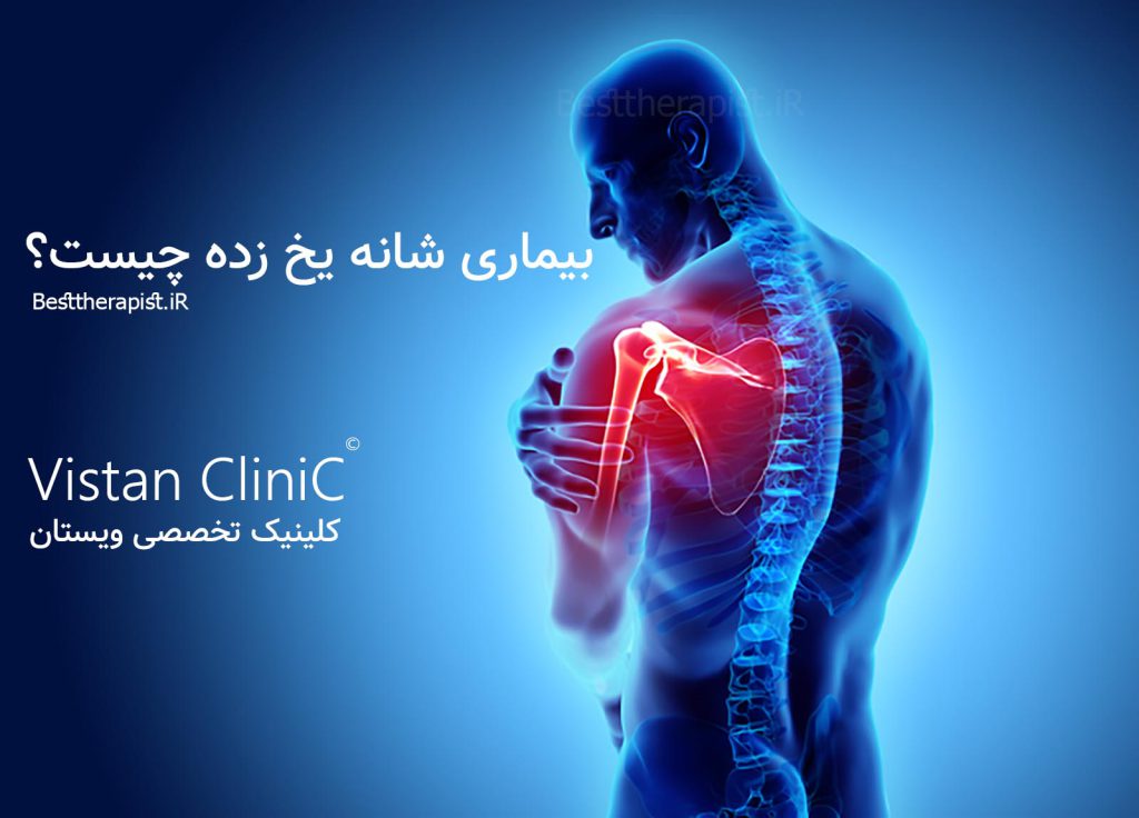 شانه یخ زده و دردهای شدید شانه
