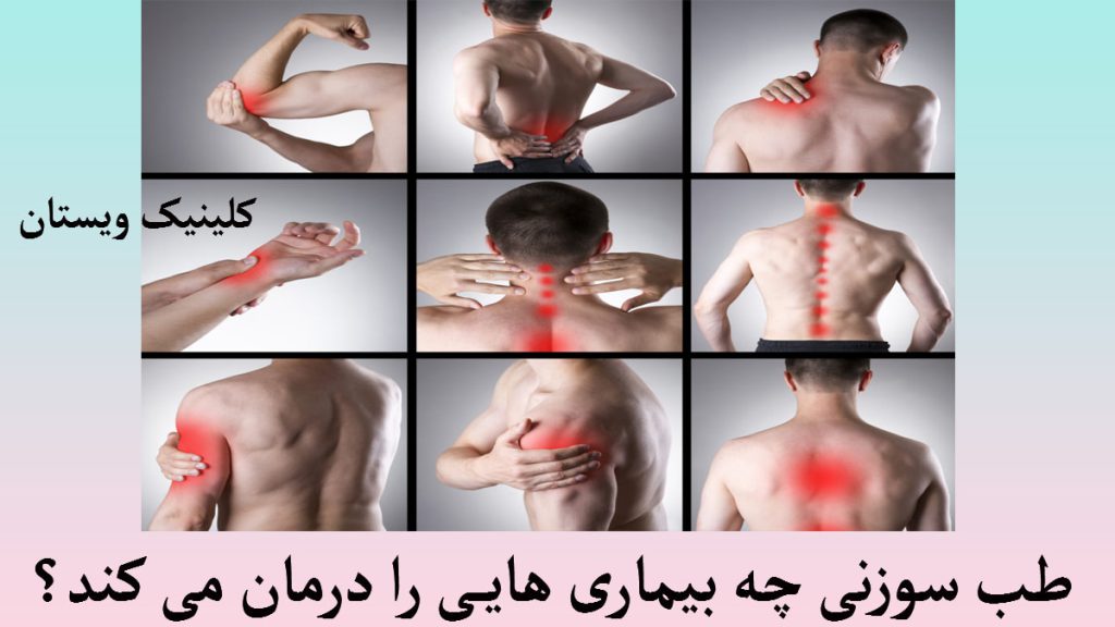 انواع مختلف بیماری های مفاصل برای درمان با طب سوزنی