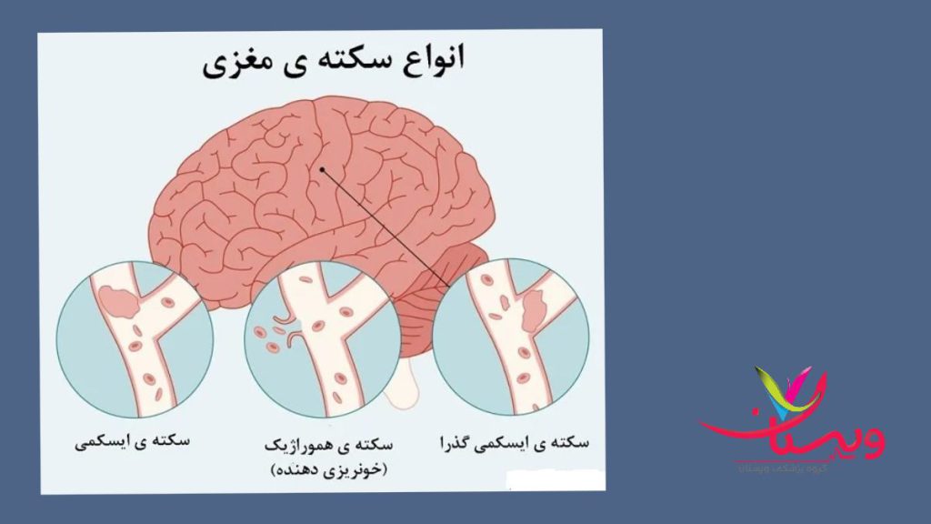 نمودار انواع سکته 